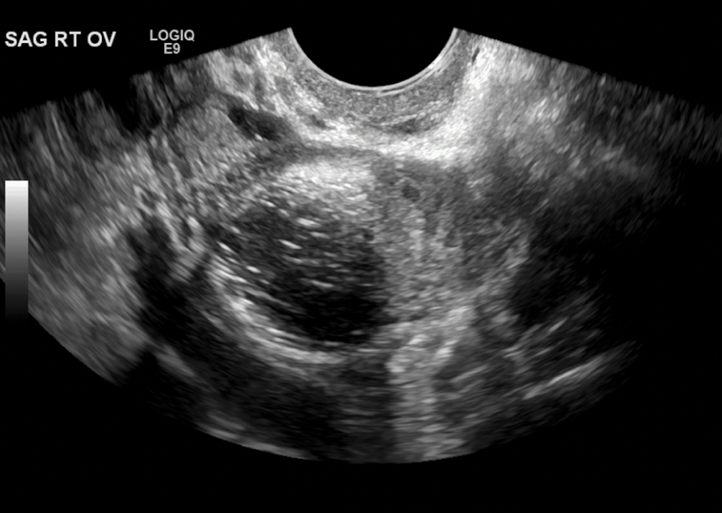 Pelvic Masses And Cysts Section Xi Office Gynecology