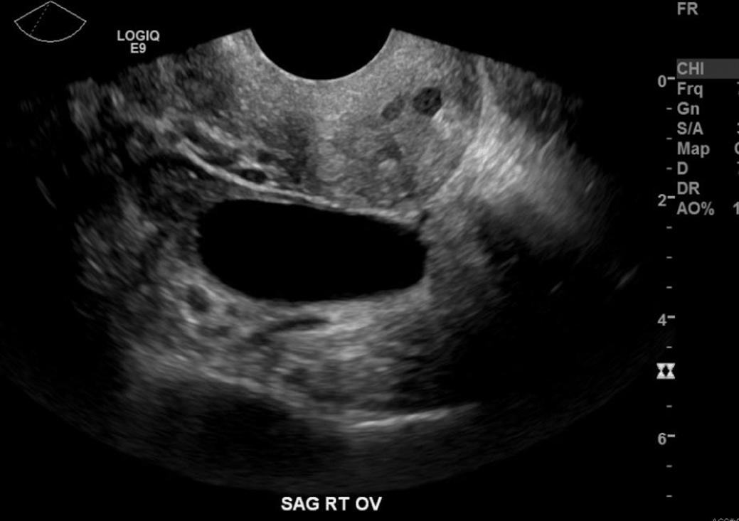 Post Menopausal Simple Ovarian Cysts