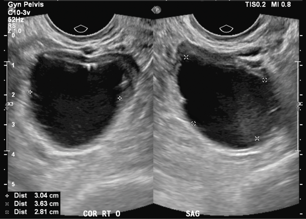 Pelvic Masses And Cysts Section Xi Office Gynecology