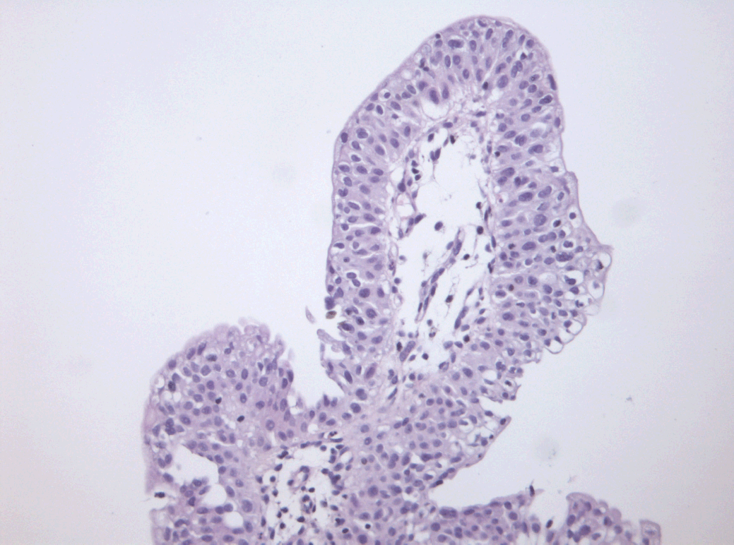 exophytic papilloma of bladder