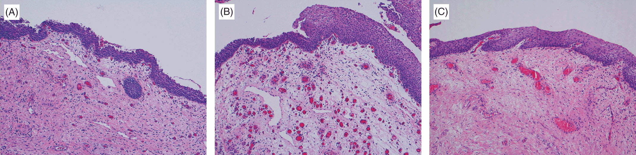 ♂♀ Pathology of the Female and Male Urethra (Chapter 25) - Gynecologic and Urologic Pathology ♂♀ Pathology of the Female and Male Urethra (Chapter 25) - Gynecologic and Urologic Pathology