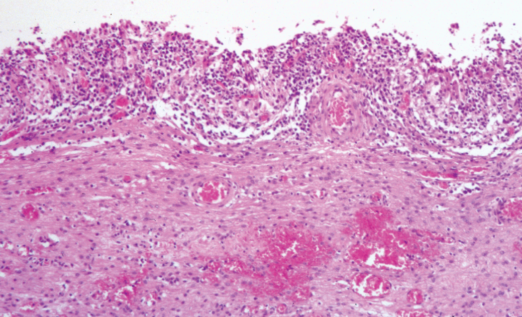 ovarian cyst histology