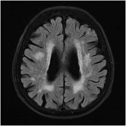 Modified Visual Magnetic Resonance Rating Scale for Evaluation of ...