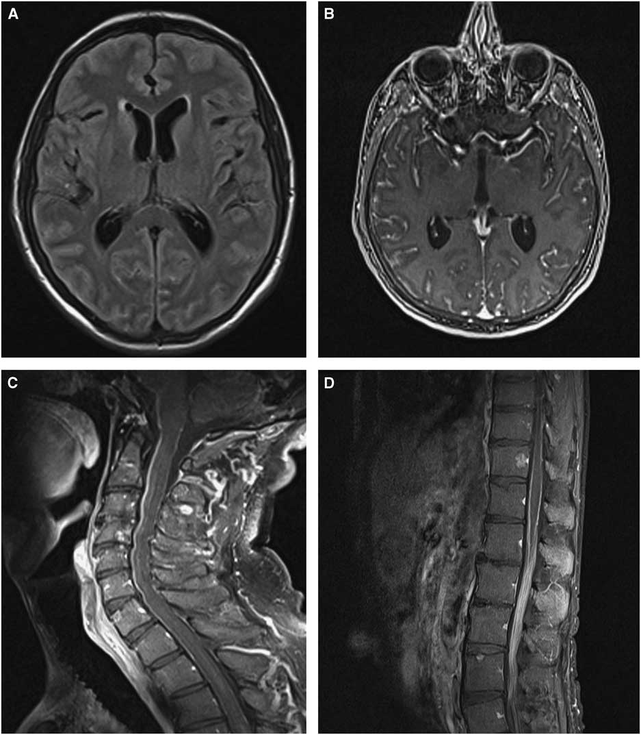 Profound Leptomeningeal and Intramedullary Abnormalities in Bing-Neel ...