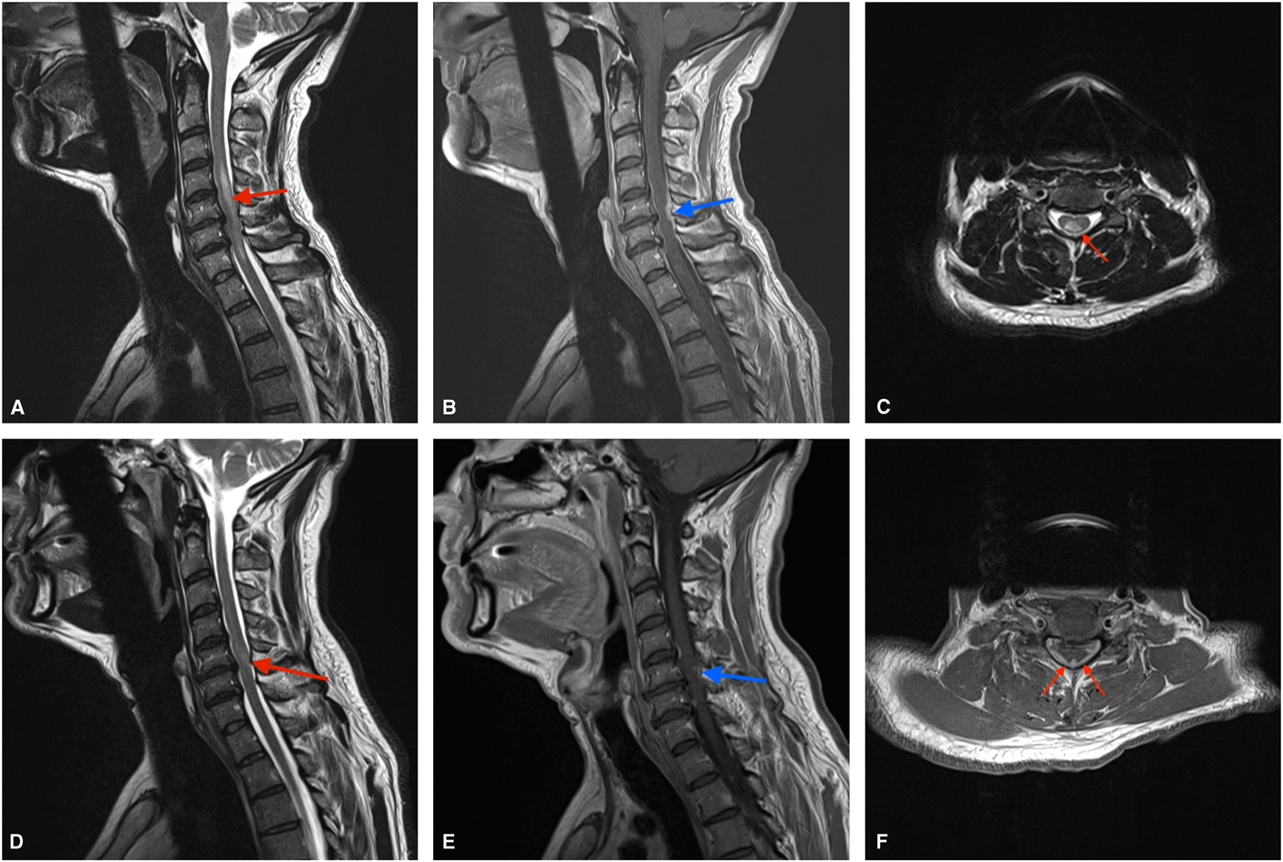 Myelitis with Hypoglycorrhachia due to Herpes Simplex Virus 2 in an