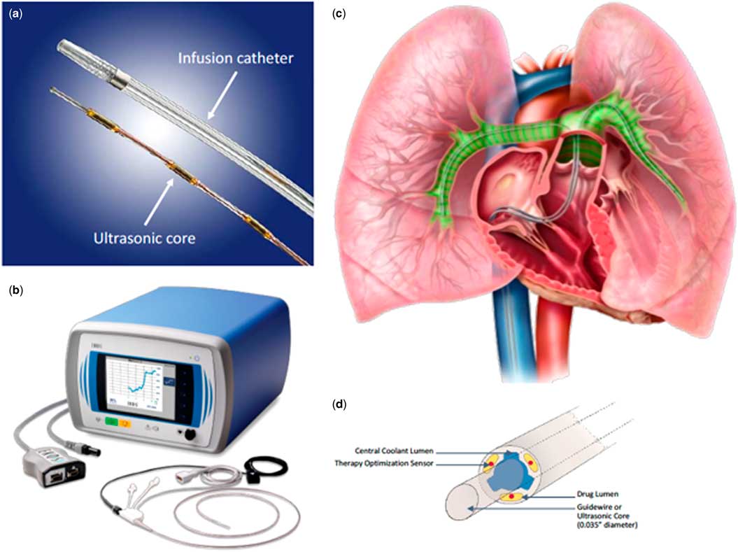 Catheterdirected therapy for acute pulmonary embolism in children