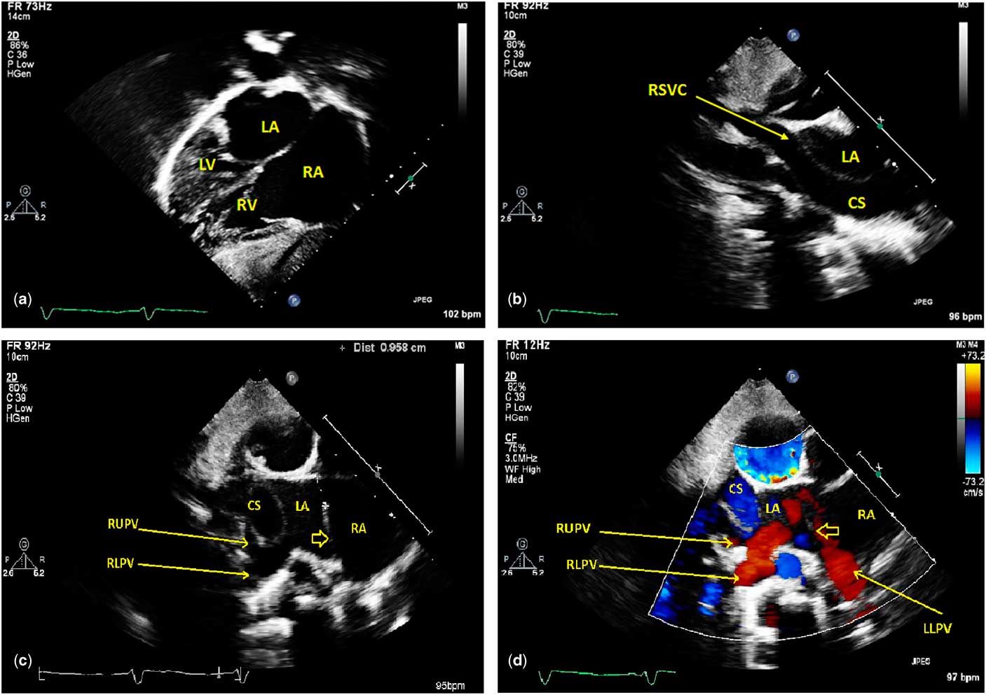 Rare Case Of Septum Primum Malposition Defect In Dextrocardia And Situs