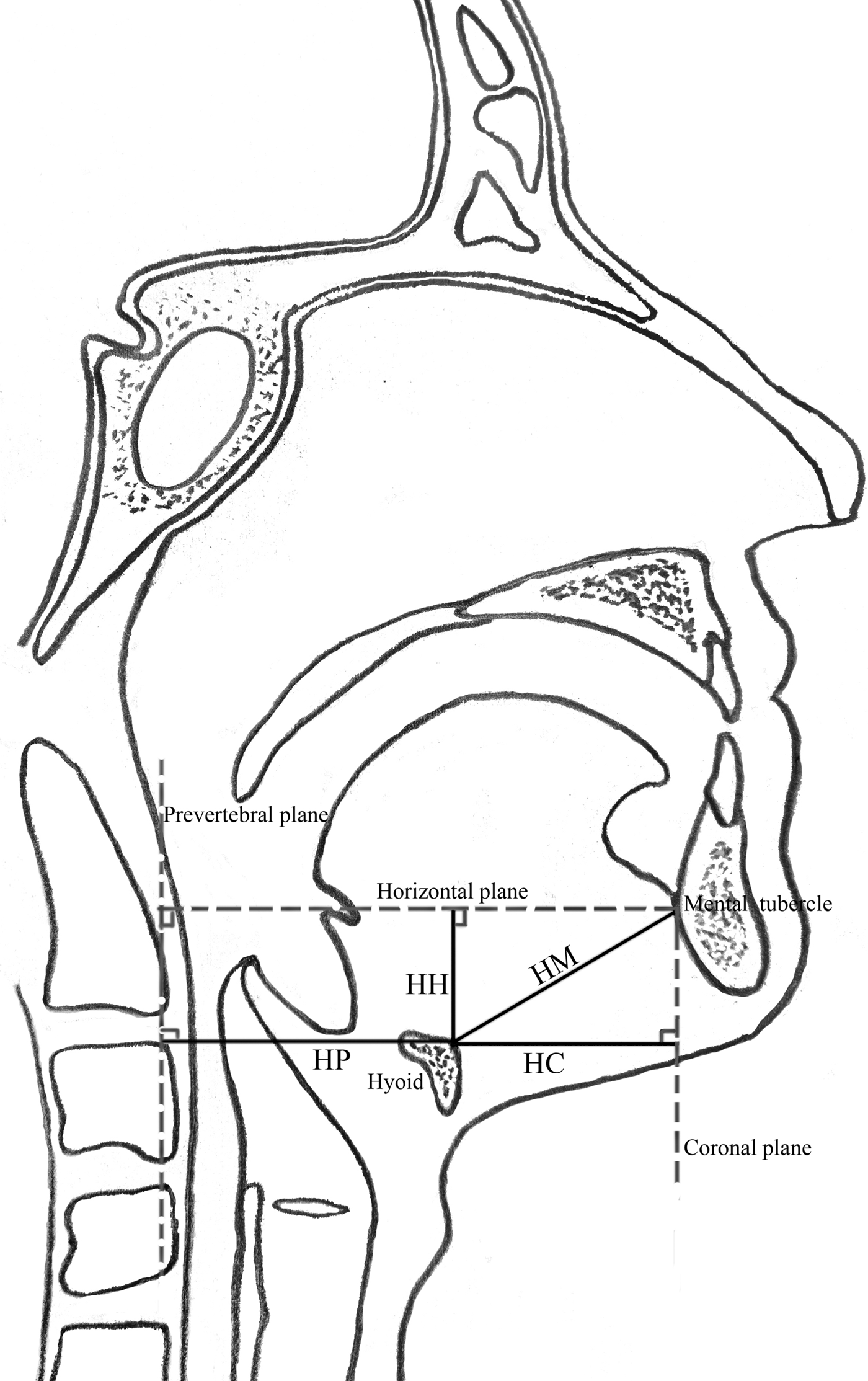 Predictive value of hyoid cephalometrics for retroglossal obstruction ...