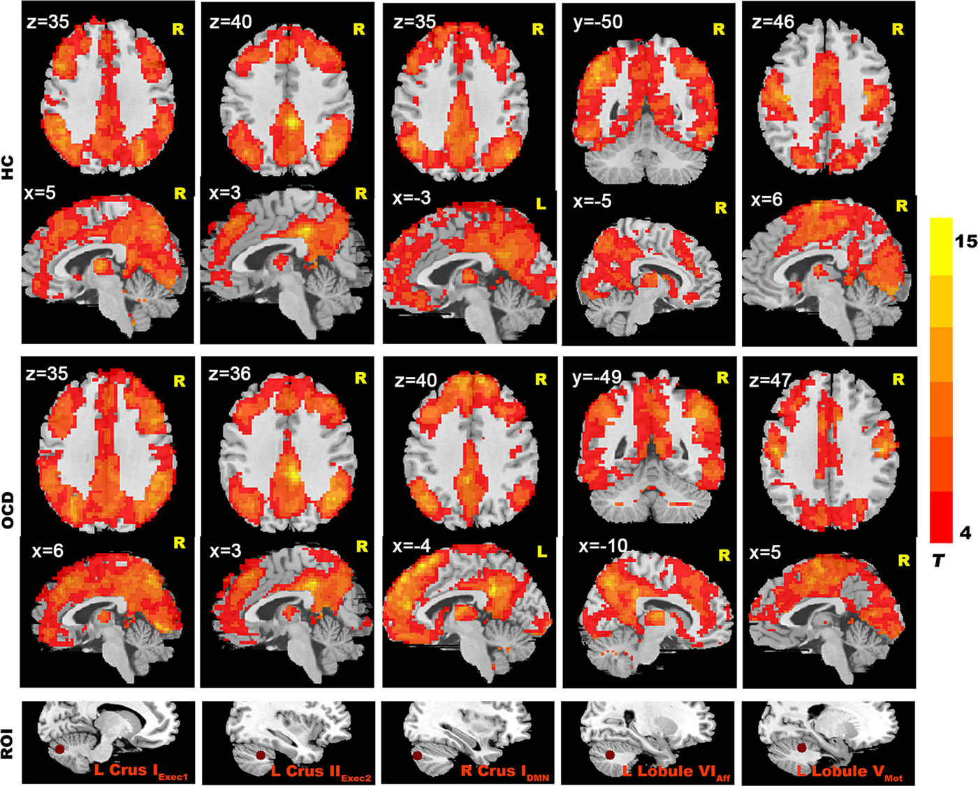 Altered Resting State Cerebellar Cerebral Functional Connectivity In Obsessive Compulsive 9513