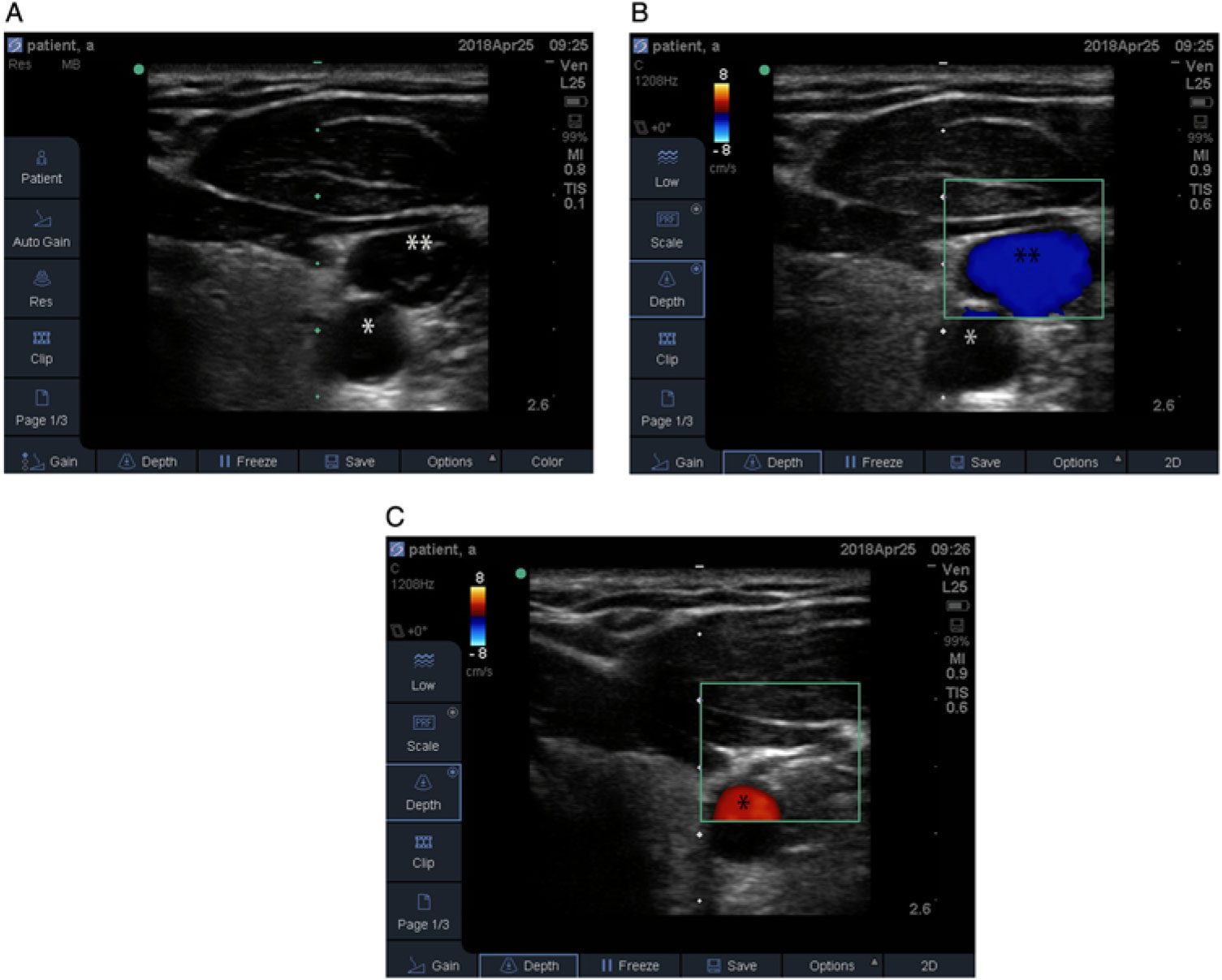 Ultrasound Diagnosis Of Transverse Sinus Hypoplasia Using, 57% OFF