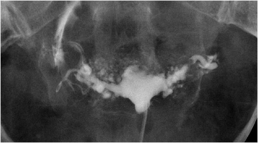 Assessment Of Fallopian Tube Patency Chapter 8 Subfertility Reproductive Endocrinology And Assisted Reproduction