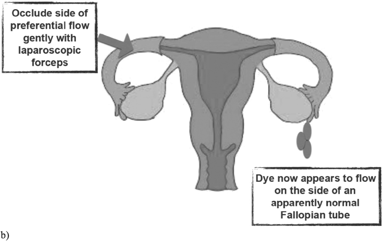 Assessment Of Fallopian Tube Patency Chapter 8 Subfertility Reproductive Endocrinology And Assisted Reproduction