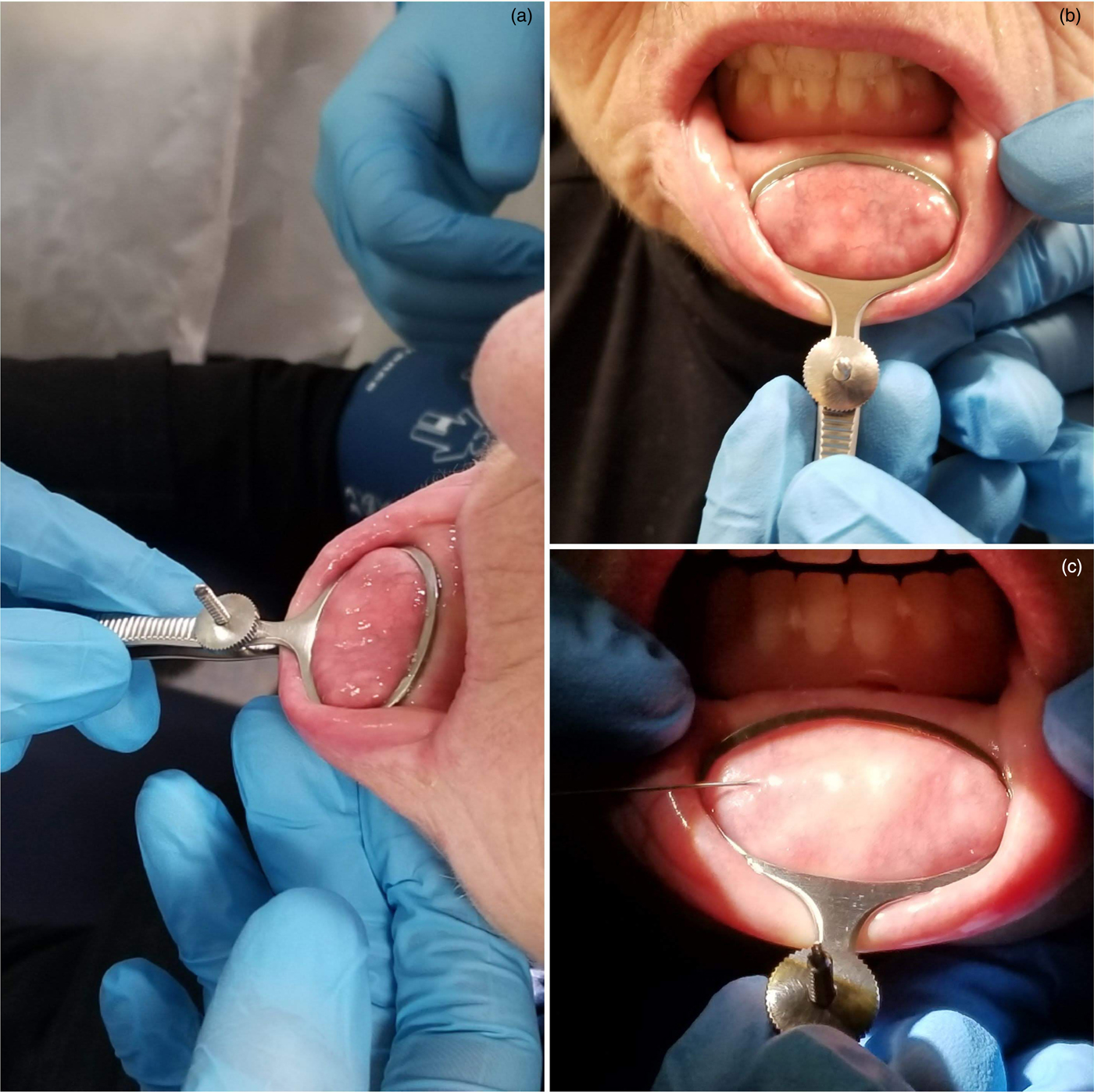 Dry Surgical Field Minor Salivary Gland Harvest Using A Chalazion Clamp For Sicca Syndrome The