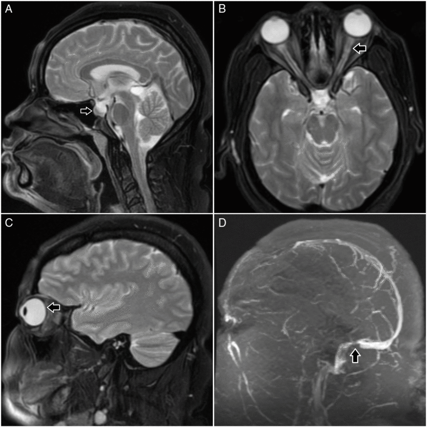 An Evolving Therapy – Dural Venous Sinus Stenting For Idiopathic ...