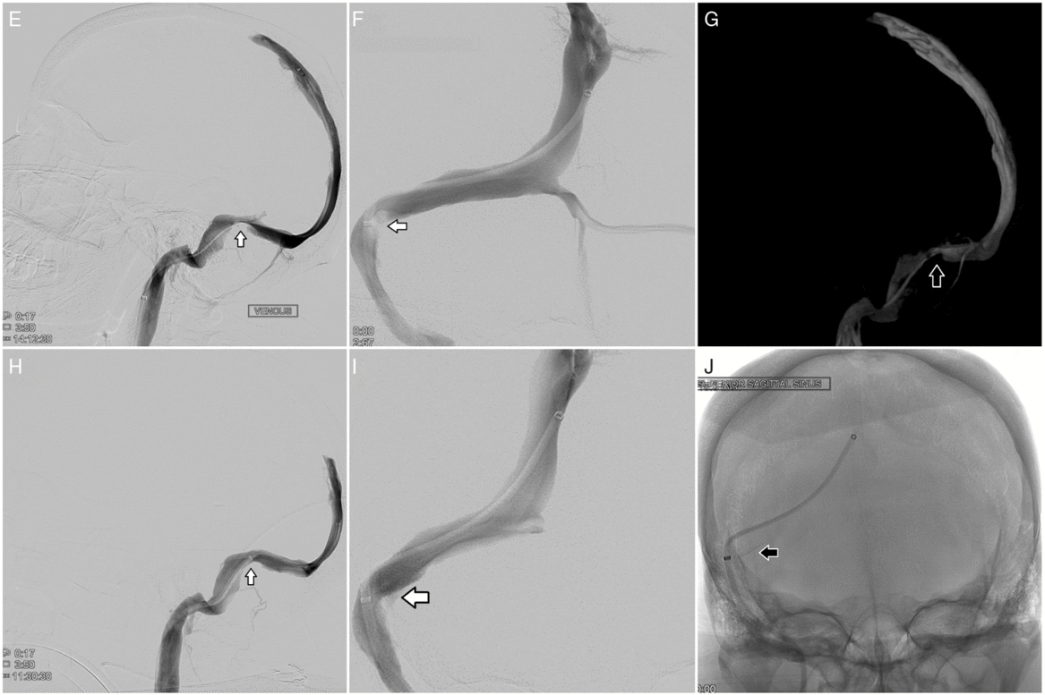 An Evolving Therapy – Dural Venous Sinus Stenting For Idiopathic ...