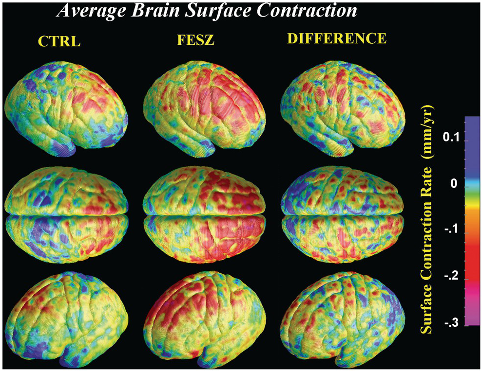 Solving a Rubik's Cube: The Role of The Basal Ganglia and Cerebellum for  Combination Puzzles