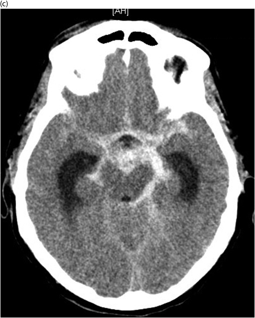 interpeduncular cistern hemorrhage