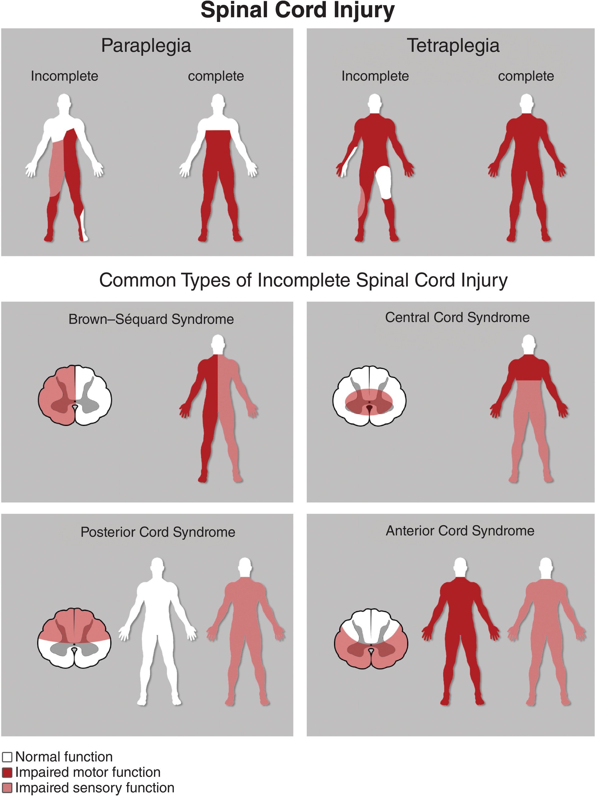 Management of the Spinal Cord Injury in the Neurocritical Care ...