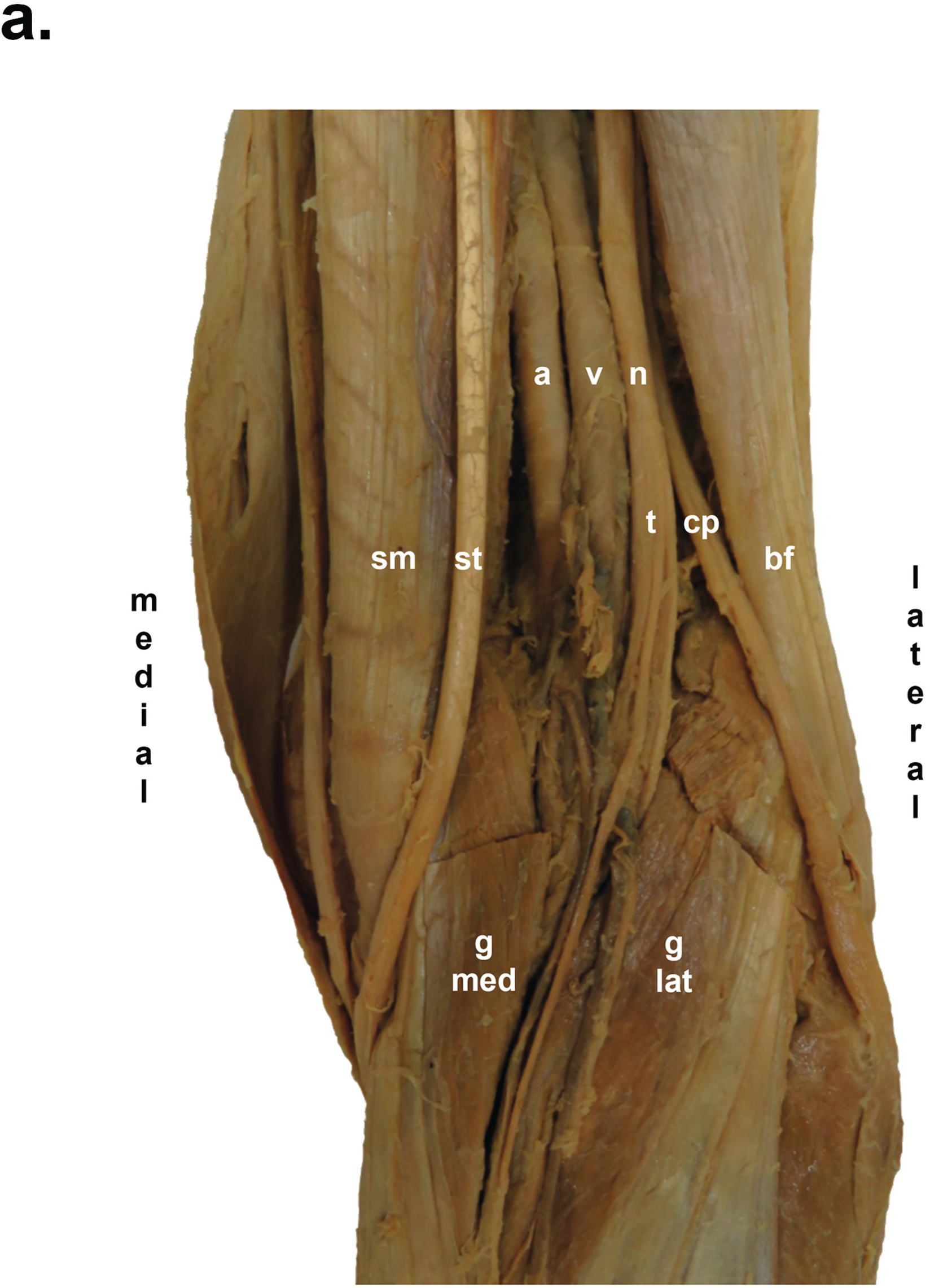 Popliteal Fossa And Block Saq 11 Anatomy For The Frca