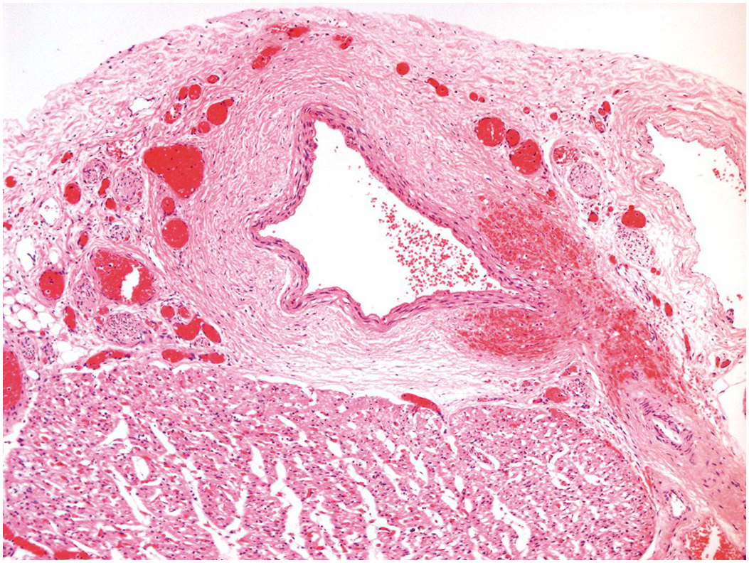 Pericardium (Chapter 11) - Pathology of Heart Disease in the Fetus, Infant  and Child, image size:1053x792