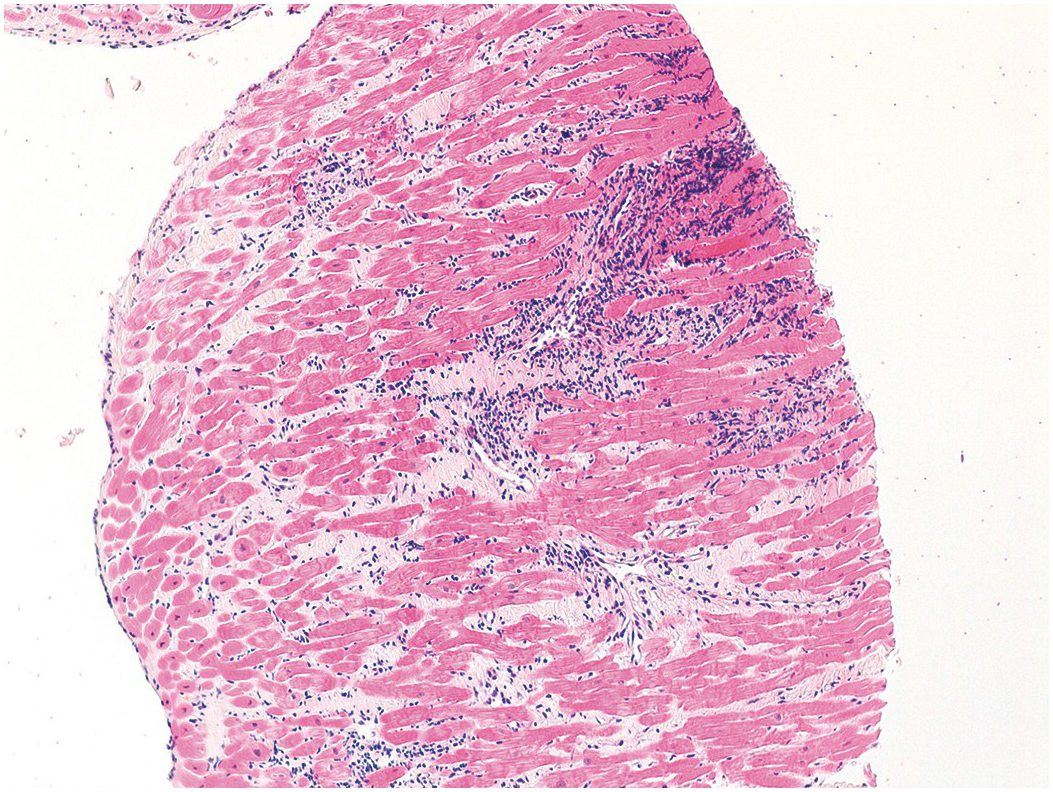bacterial endocarditis histology