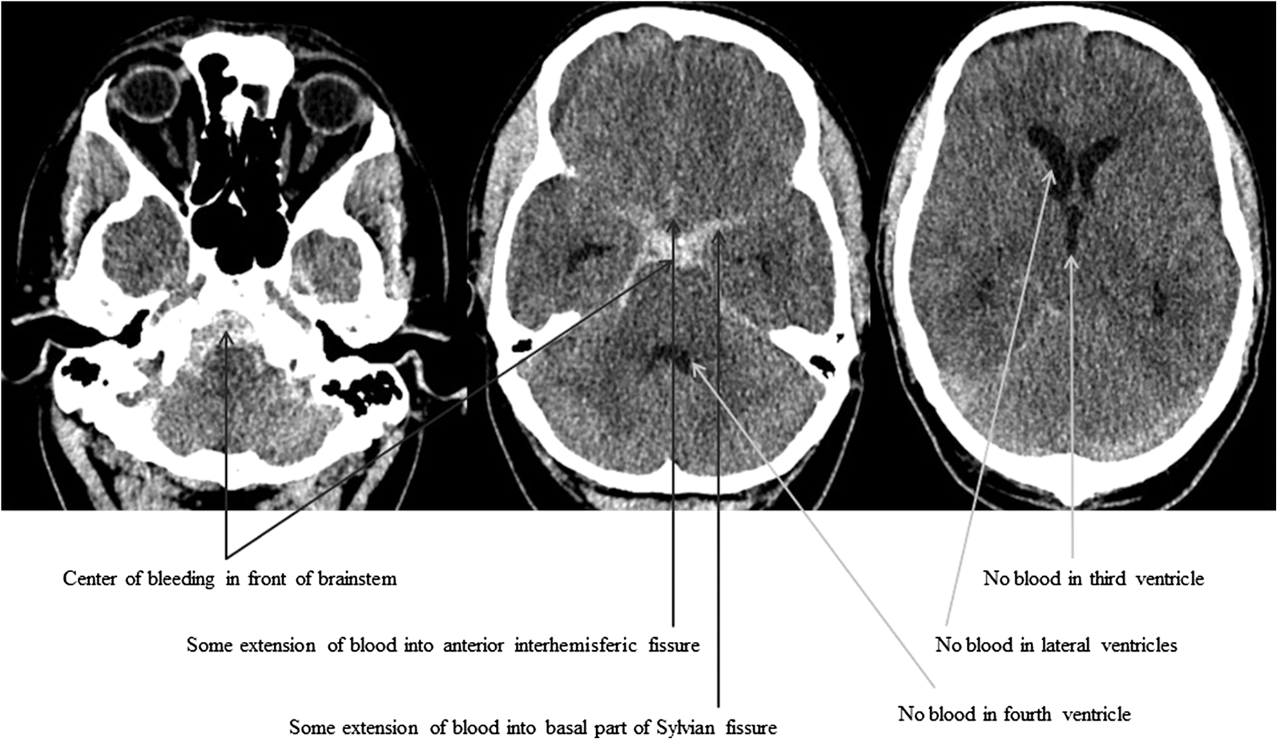 Subarachnoid hemorrhage  Radiology Reference Article
