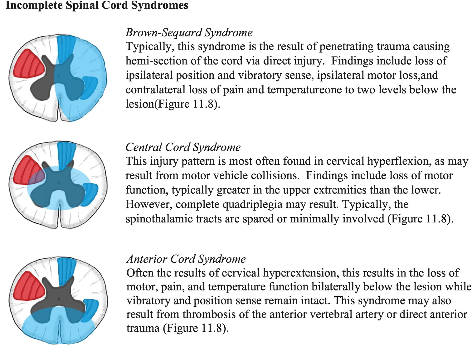 Incomplete Spinal Cord Injuries Spine Orthobullets, 56% OFF