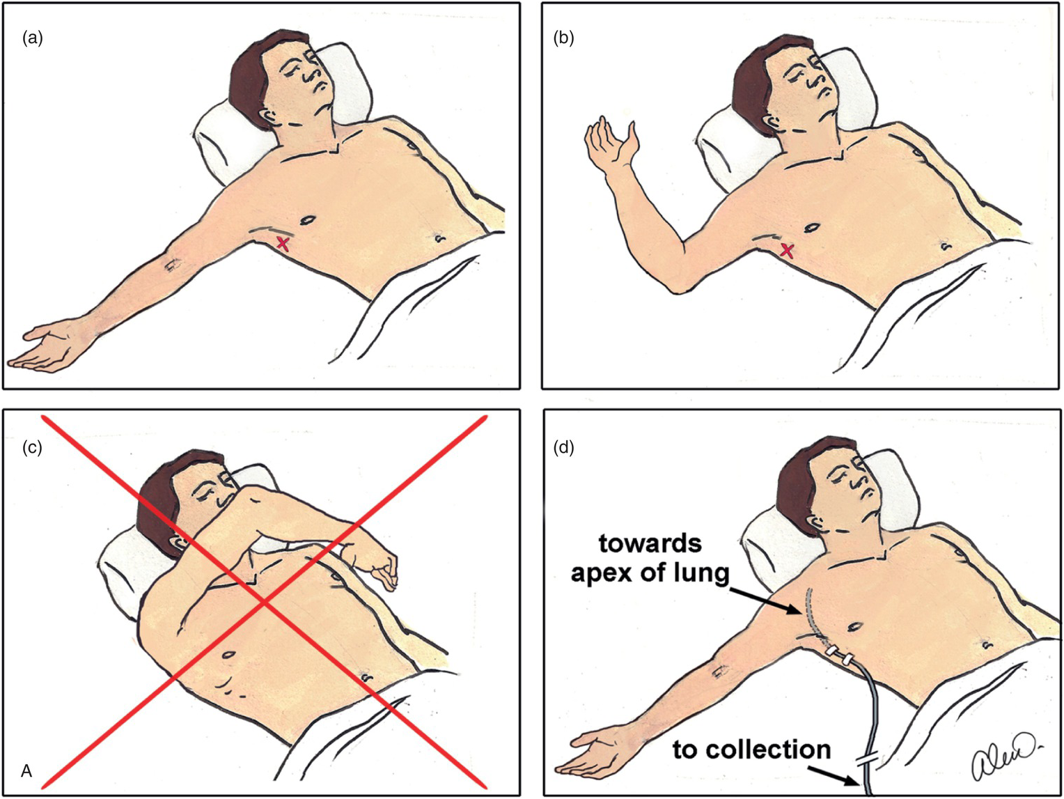 Pulmonary Trauma Chapter 13 The Emergency Medicine Trauma Handbook