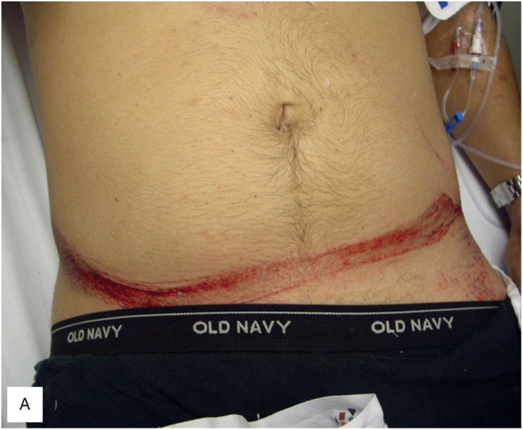 Abdominal and Flank Trauma (Chapter 15) - The Emergency Medicine Trauma Handbook Abdominal and Flank Trauma (Chapter 15) - The Emergency Medicine Trauma Handbook