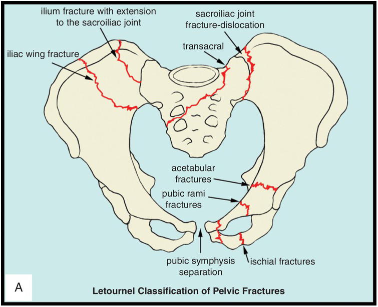 Superior Pubic Ramus Fracture