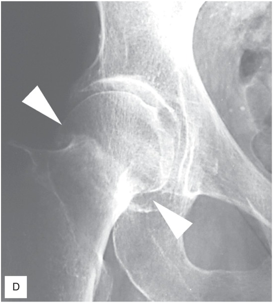 Pelvic Trauma (Chapter 18) - The Emergency Medicine Trauma Handbook