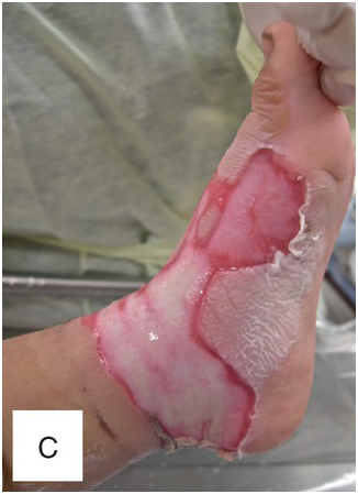 BURN INJURY , HAND BURNS, ELECTRICAL BURNS.: NEGLECTED ELECTRICAL