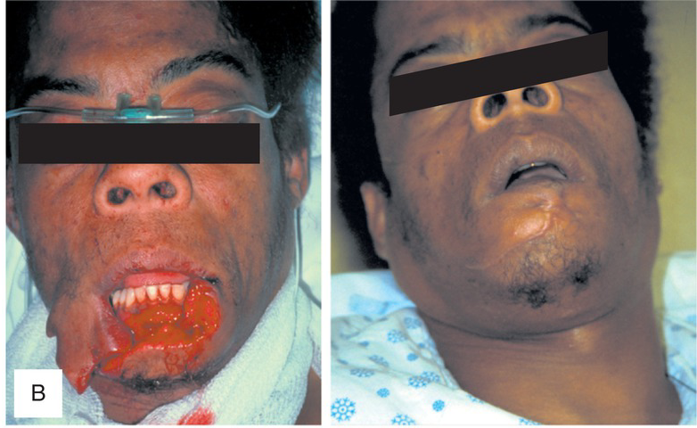 Facial Fracture Repair NYC  Facial Injuries New Jersey