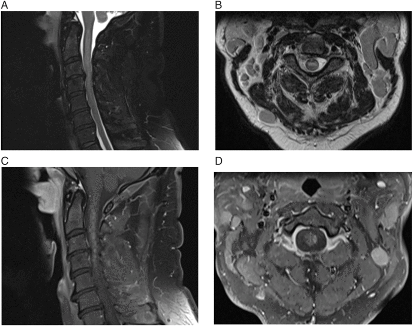 Central Nervous System Involvement with Chronic Lymphocytic Leukemia ...