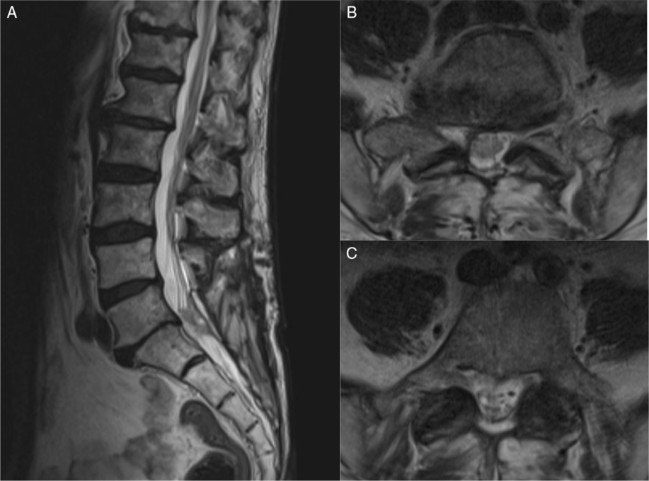 Intradural Metastasis from Cutaneous Squamous Cell Carcinoma Causing ...