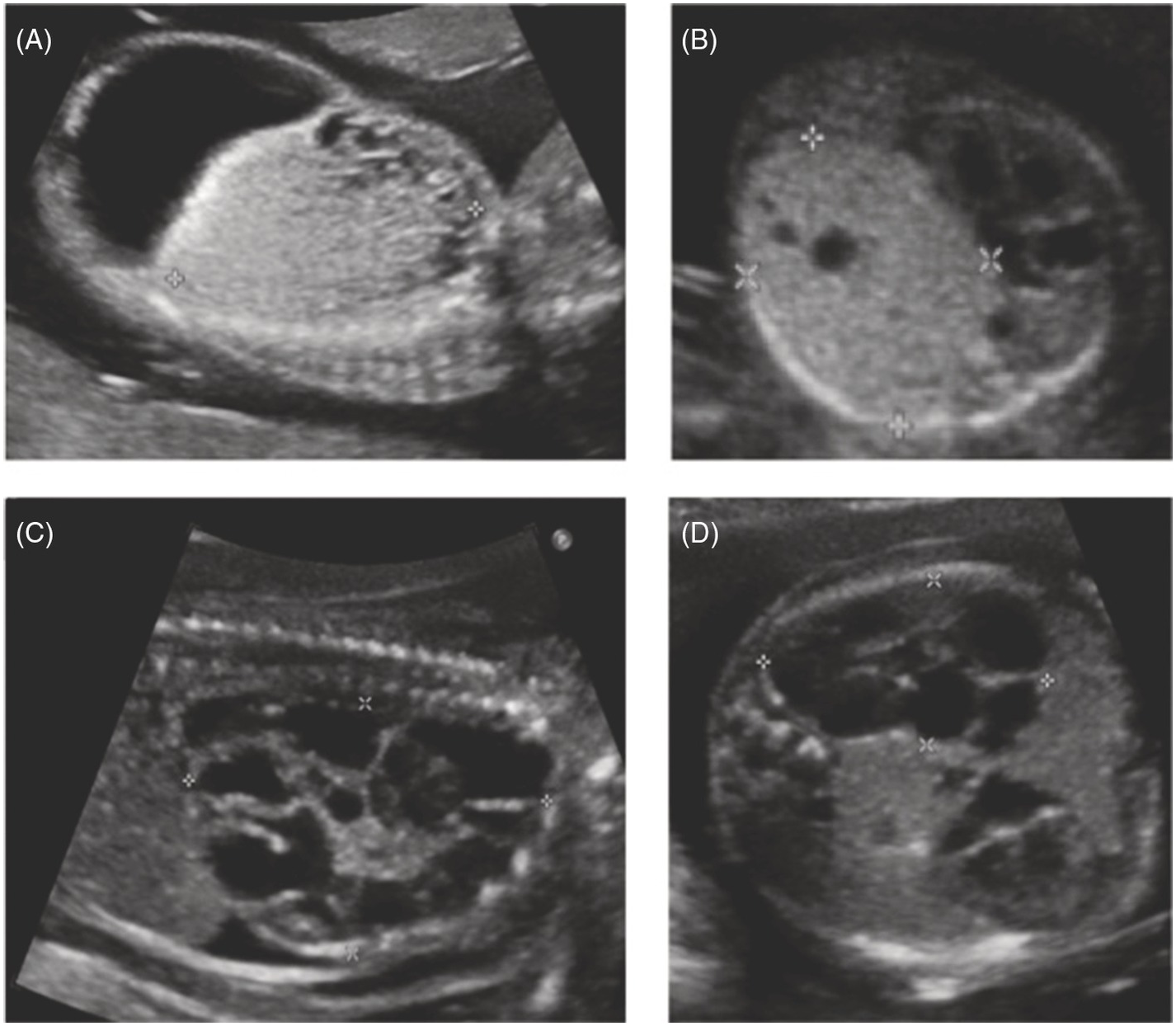 fetal pleural effusion ultrasound