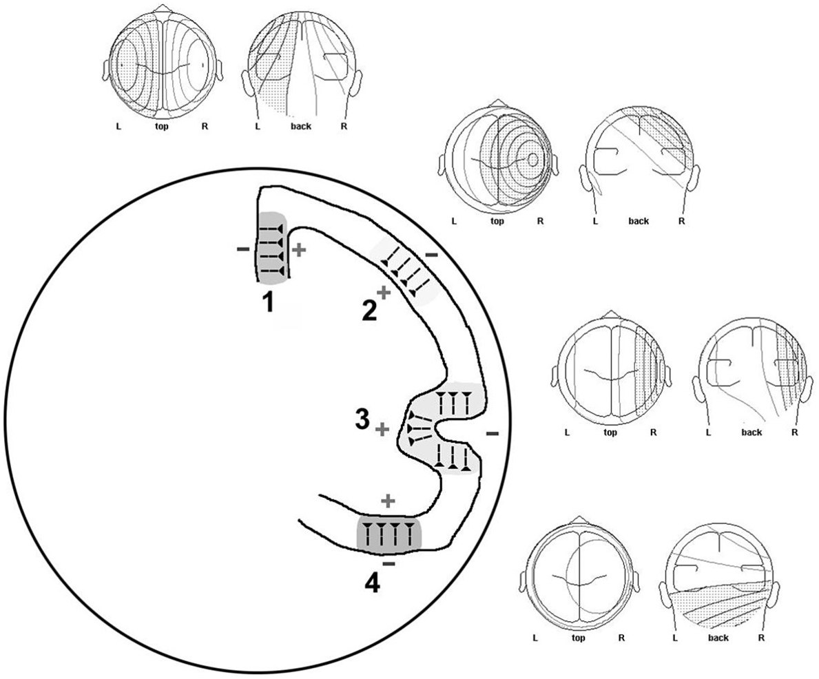 EEG Instrumentation and Basics (Chapter 11) - Understanding Epilepsy