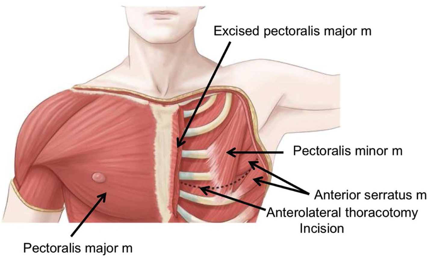 Bell-shaped chest is demonstrated with small upper chest. Musculature