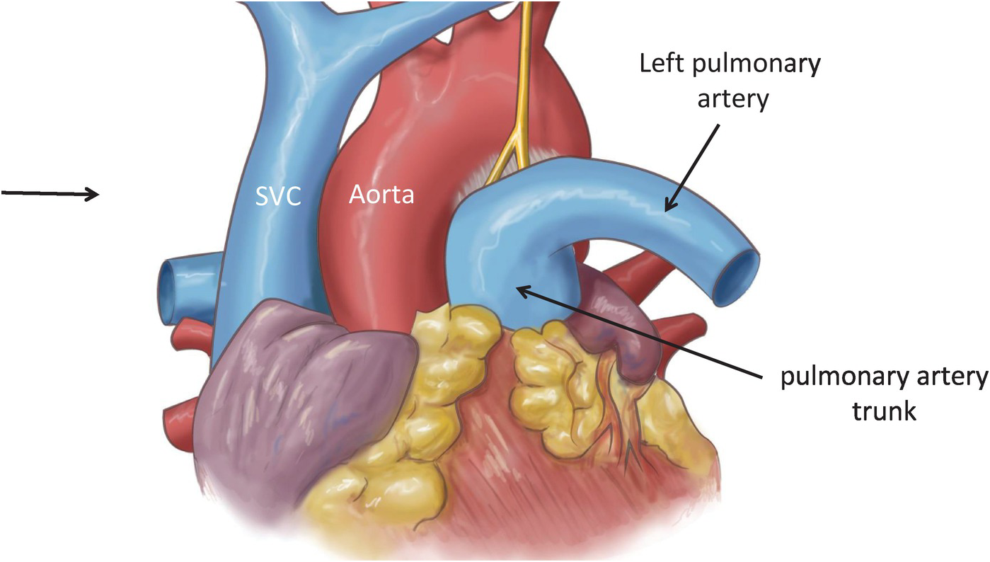 Pulmonary Ligament Lung pulmonary-ligament-lung