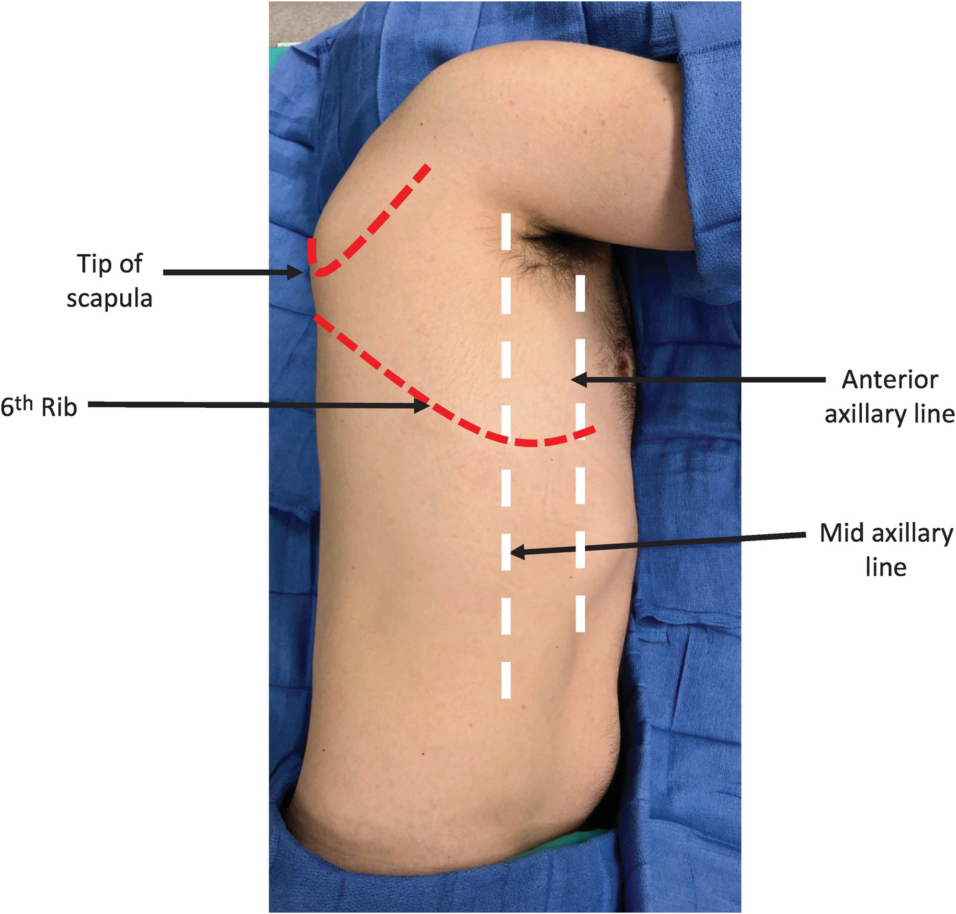 Port Position of Various Thoracoscopic Surgeries