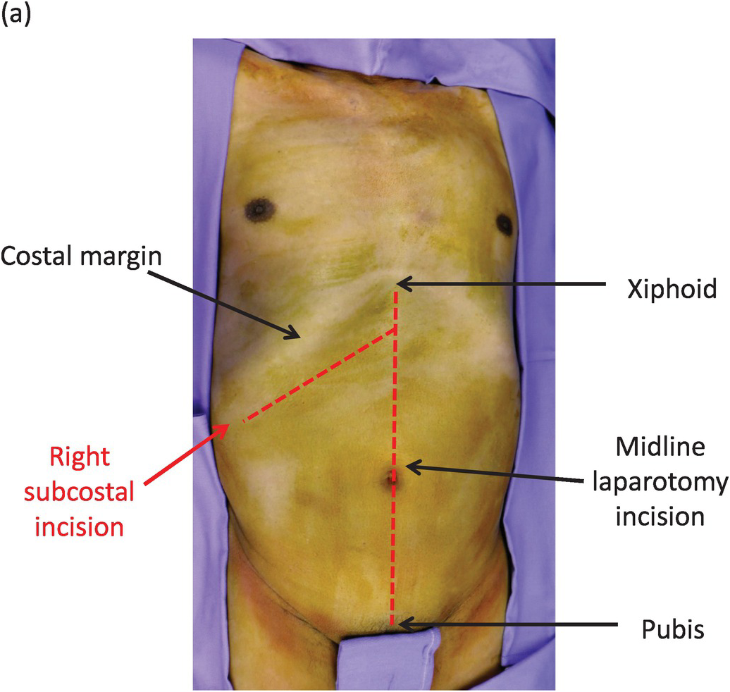 left subcostal incision