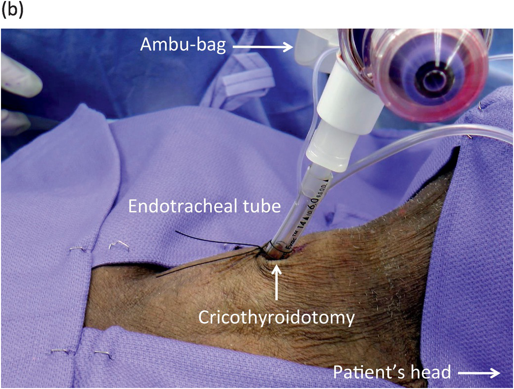 Bag Valve Mask | BVM Ventilation | Ambu Bag - CPR Select