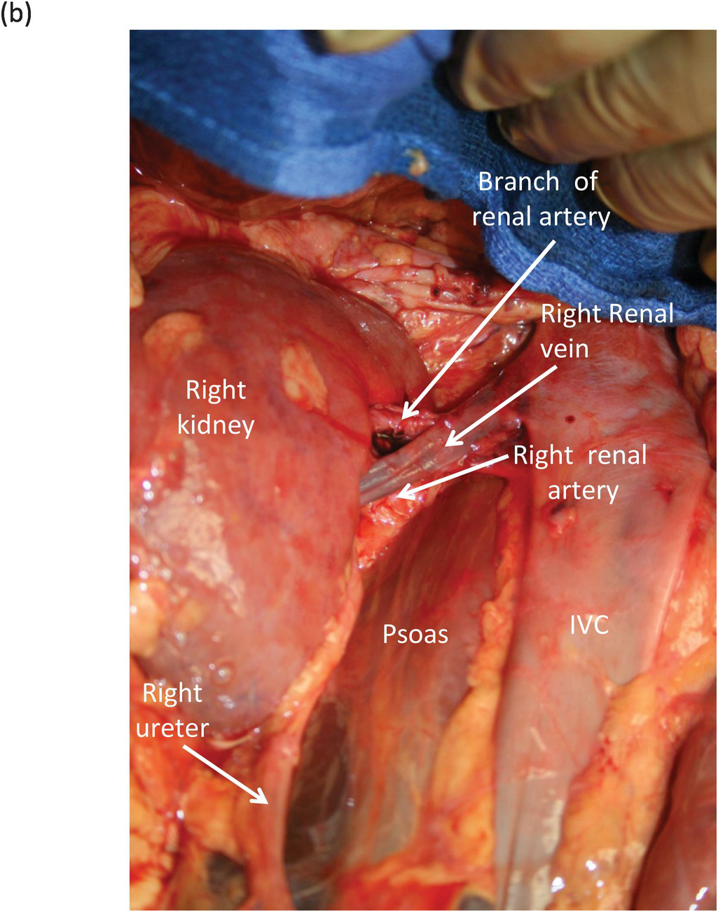 ureteral renal vein