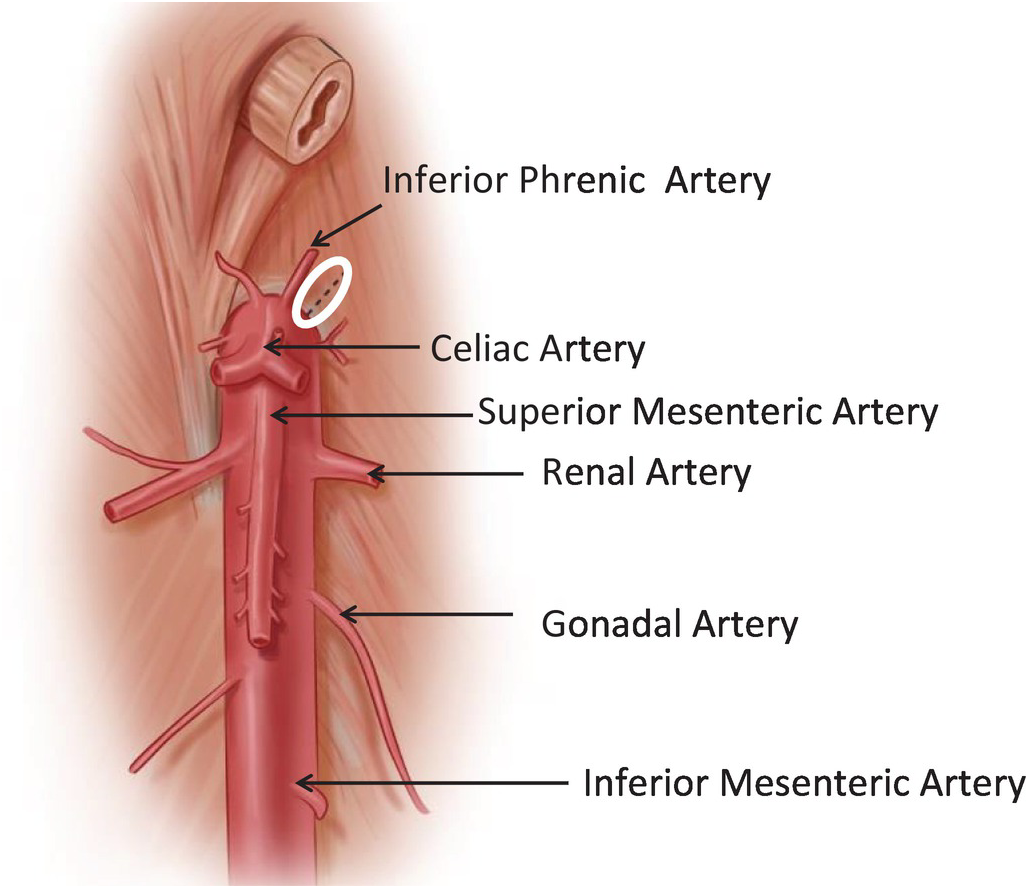Abdominal Aorta Branches Anatomy