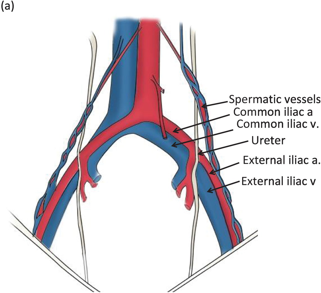 Common Iliac Vein Anatomy Function And Diagram Body M - Vrogue.co