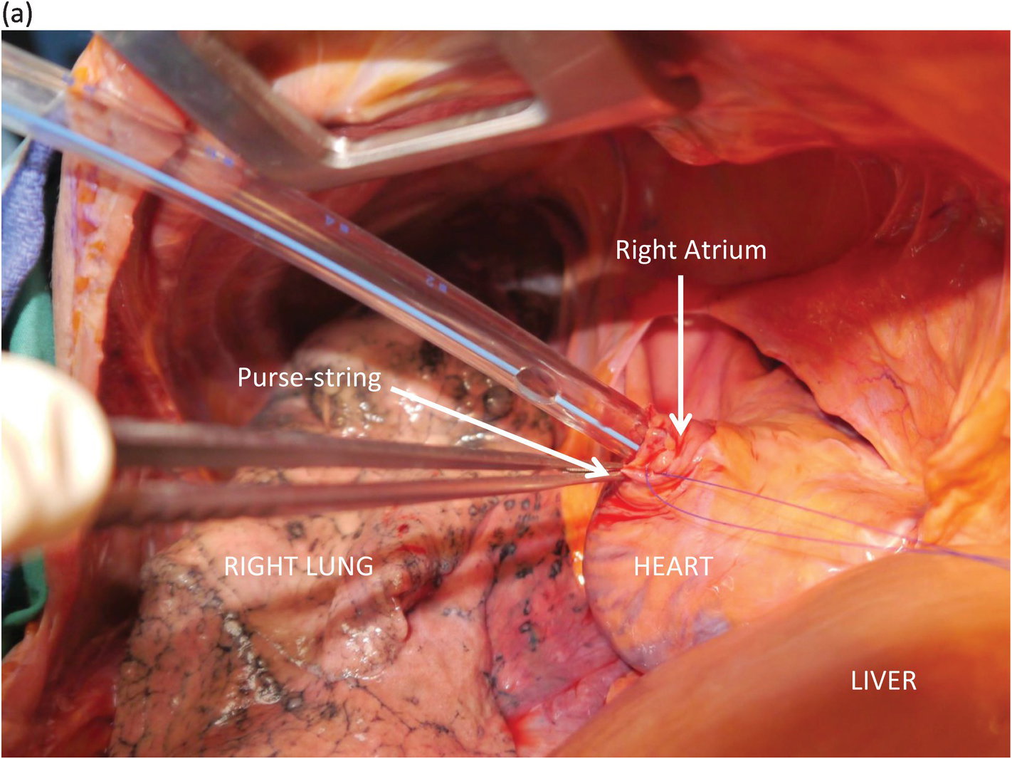 Double-nylon purse-string suture in closing postoperative wounds following  endoscopic resection of large (≥ 3 cm) gastric submucosal tumors