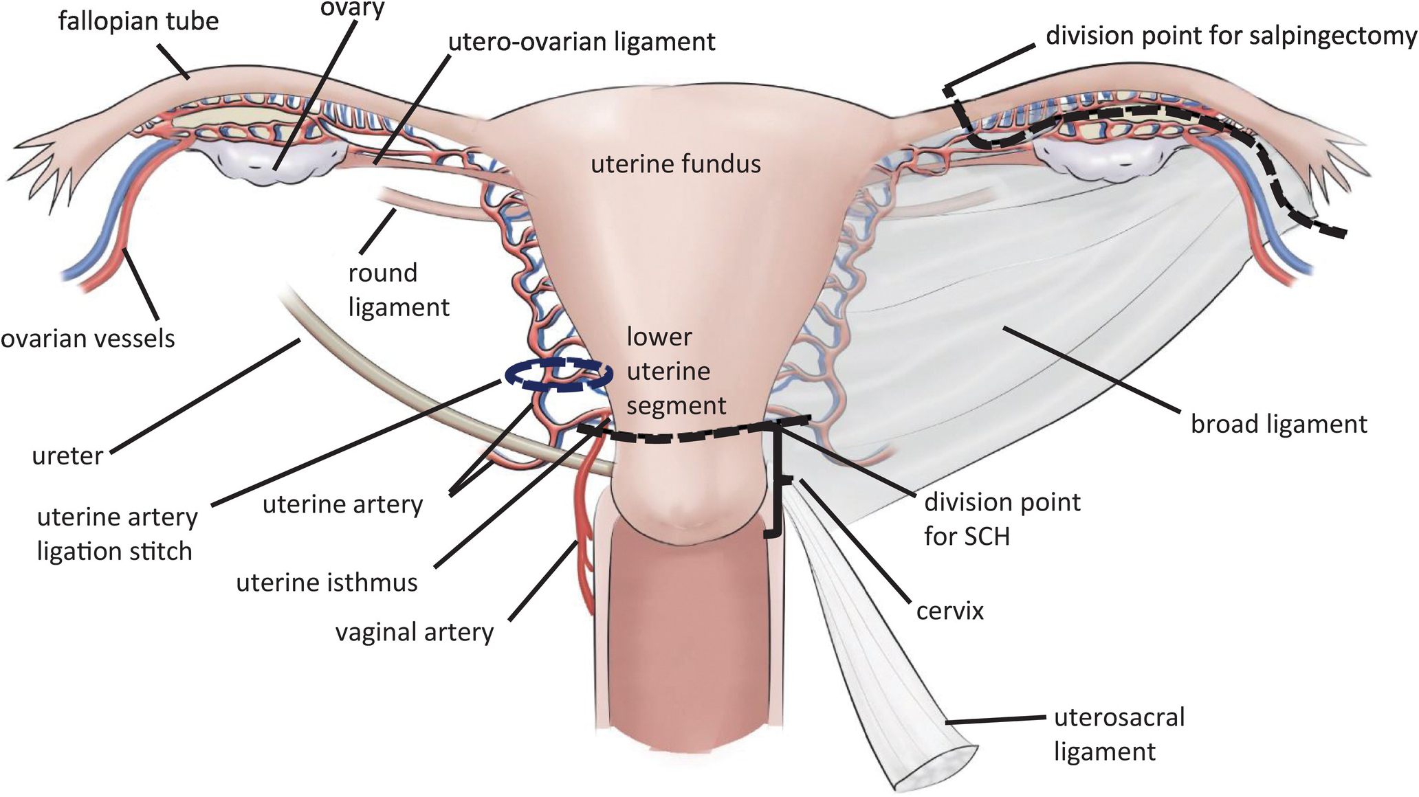 Emergency Hysterectomy Chapter 35 Atlas Of Surgical Techniques