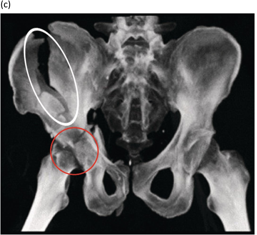 Iliac Wing Fracture