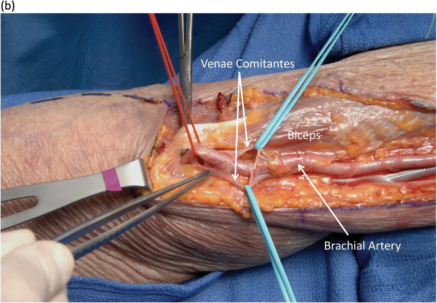 Brachial Artery Injury Chapter 37 Atlas Of Surgical Techniques In Trauma