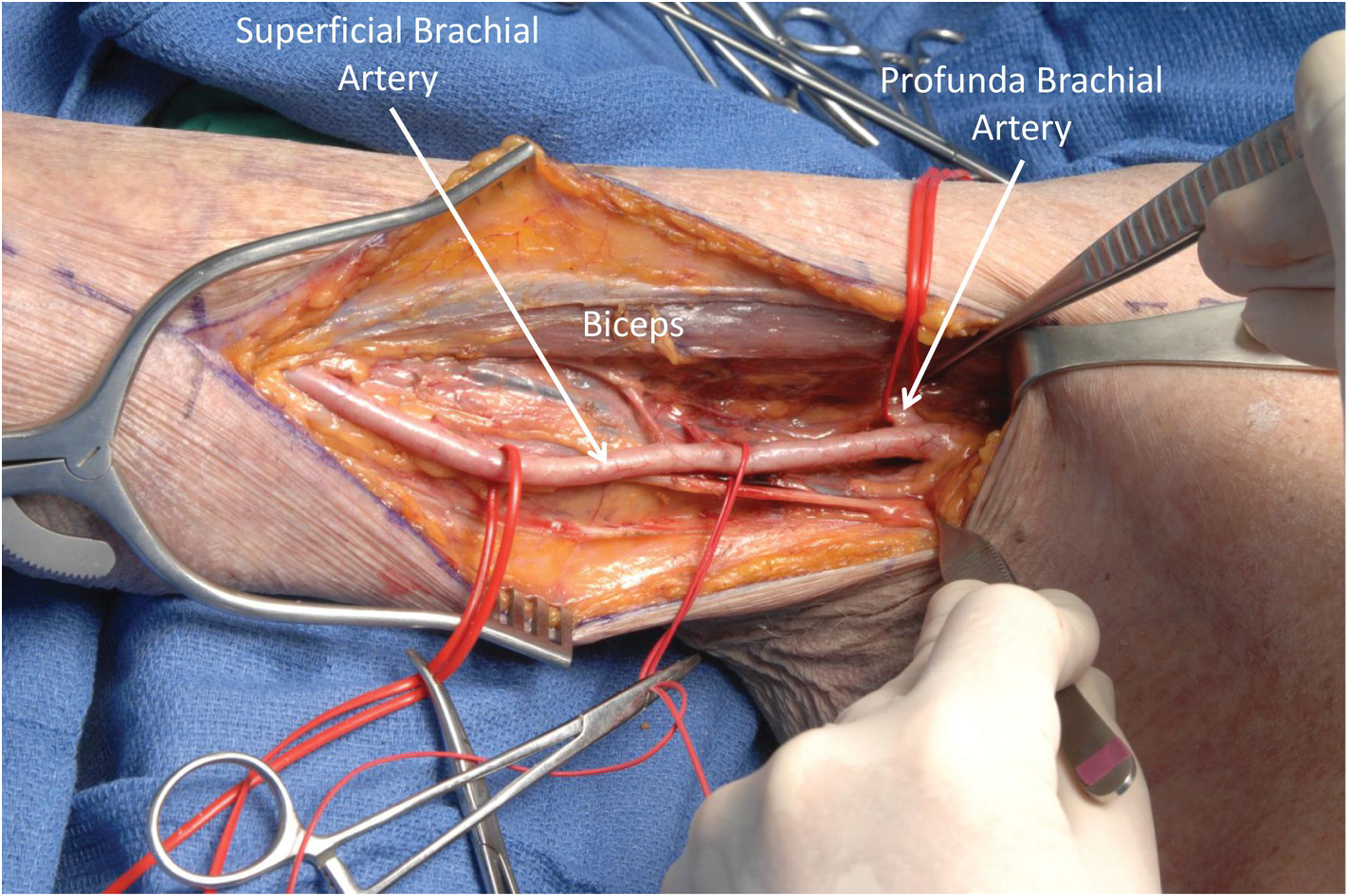 Cureus, Relationship of the Median and Radial Nerves at the Elbow:  Application to Avoiding Injury During Venipuncture or Other Invasive  Procedures of the Cubital Fossa